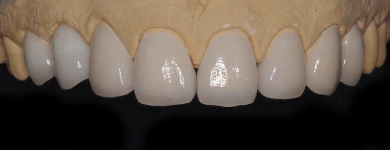 PFM/Snap-On Smile - Bright Dental Lab