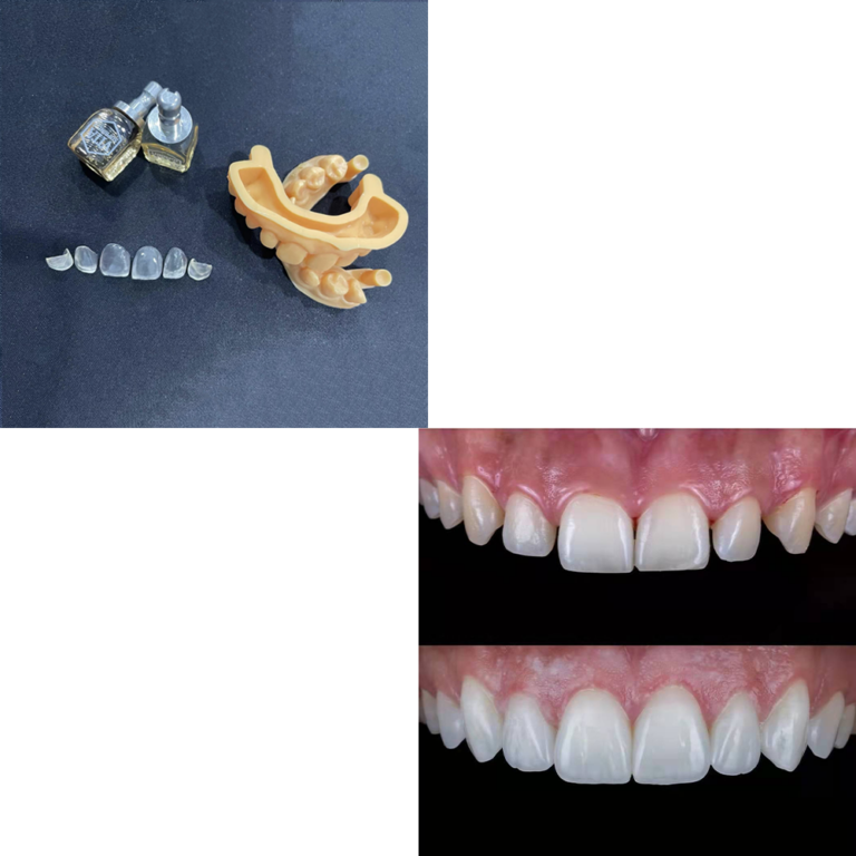 NEW CAD VENEERS - Bright Dental Lab