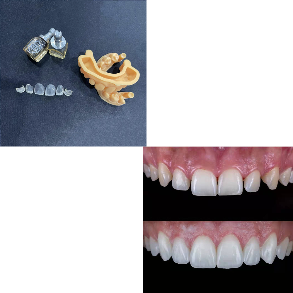 NEW CAD VENEERS - Bright Dental Lab