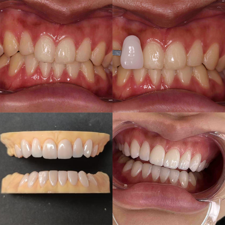 NEW CAD VENEERS - Bright Dental Lab