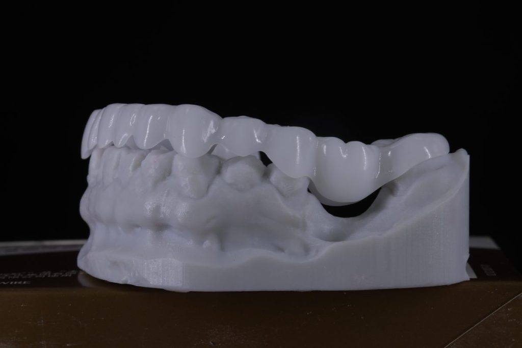 Snap-On Smile milled appliance